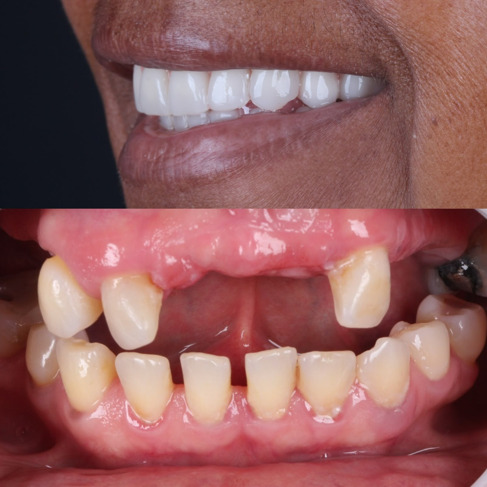 Comparação clínica de um paciente antes e após tratamento na Sorridi